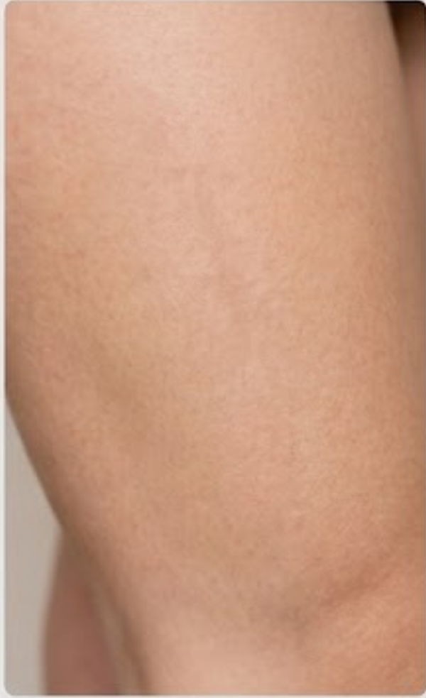 After — Scars