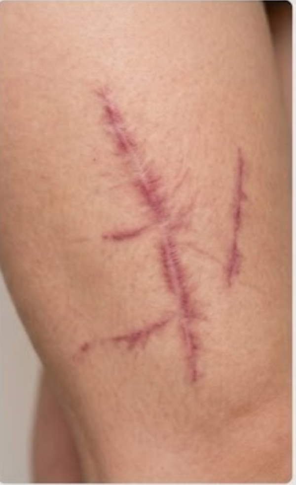 Before — Scars